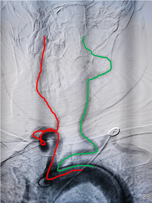 动脉长鞘怎么置入术说·第十七期丨Infinity长鞘助力Surpass Streamline血流导向密网支架治疗双侧颈内迂曲路径动脉瘤一例_https://www.jmylbn.com_新闻资讯_第7张