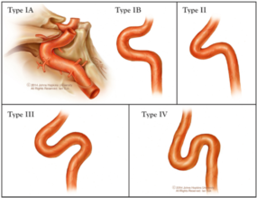 动脉长鞘怎么置入术说·第十七期丨Infinity长鞘助力Surpass Streamline血流导向密网支架治疗双侧颈内迂曲路径动脉瘤一例_https://www.jmylbn.com_新闻资讯_第12张