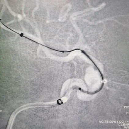 动脉长鞘怎么置入术说·第十七期丨Infinity长鞘助力Surpass Streamline血流导向密网支架治疗双侧颈内迂曲路径动脉瘤一例_https://www.jmylbn.com_新闻资讯_第25张