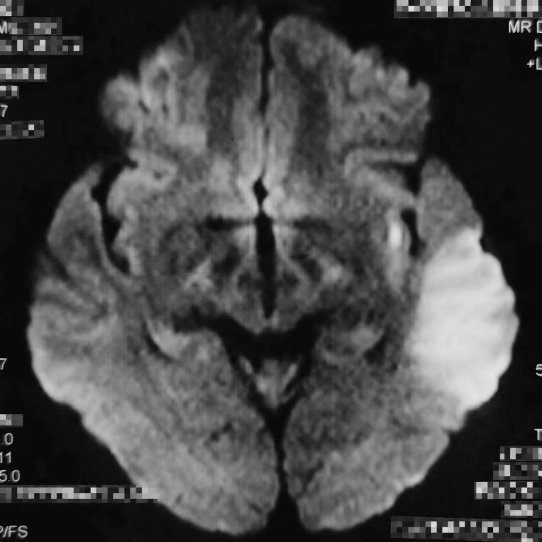 什么叫桡鞘Epath®长鞘经桡入路丨冯军教授团队：Epath®长鞘经桡入路行颈动脉狭窄CAS术一例_https://www.jmylbn.com_新闻资讯_第5张