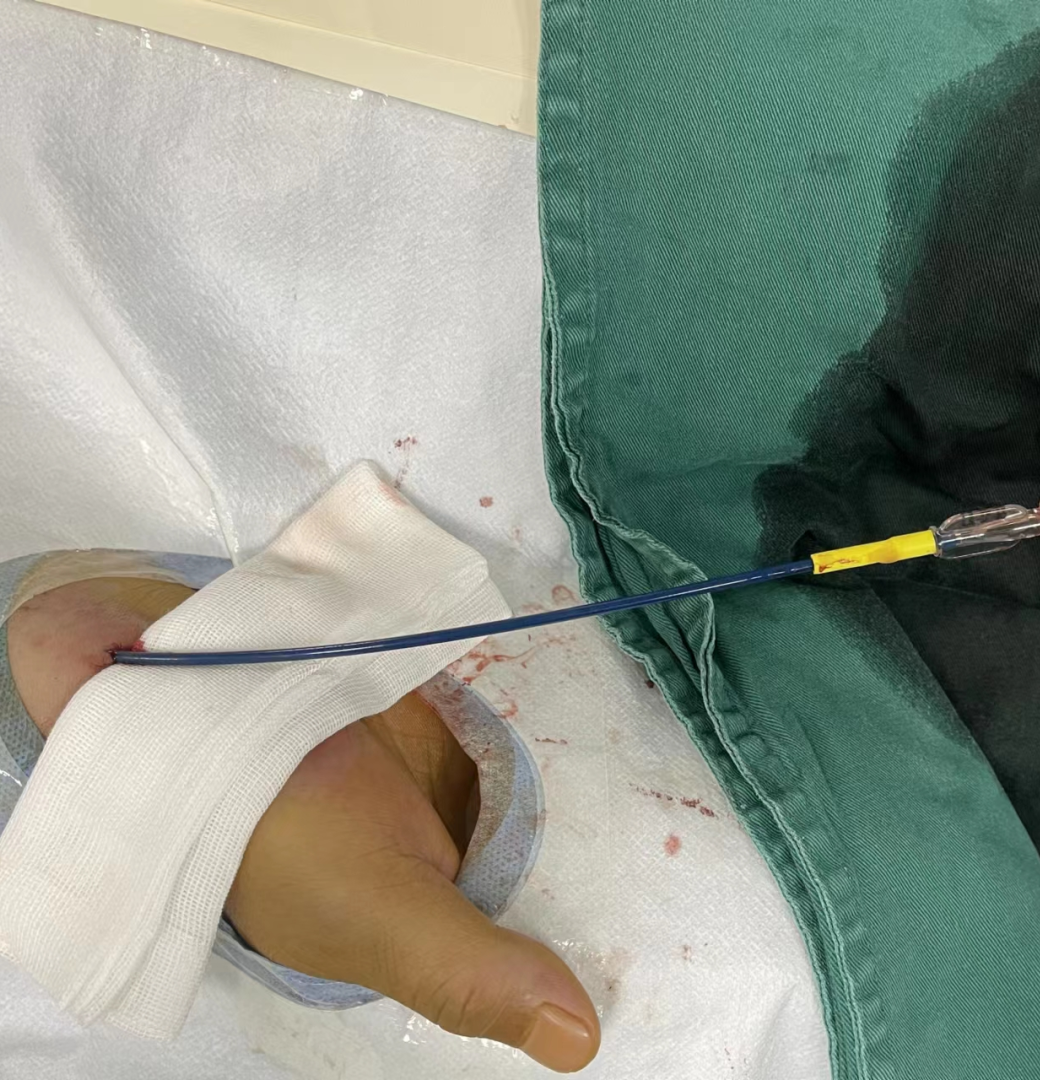 什么叫桡鞘Epath®长鞘经桡入路丨冯军教授团队：Epath®长鞘经桡入路行颈动脉狭窄CAS术一例_https://www.jmylbn.com_新闻资讯_第8张