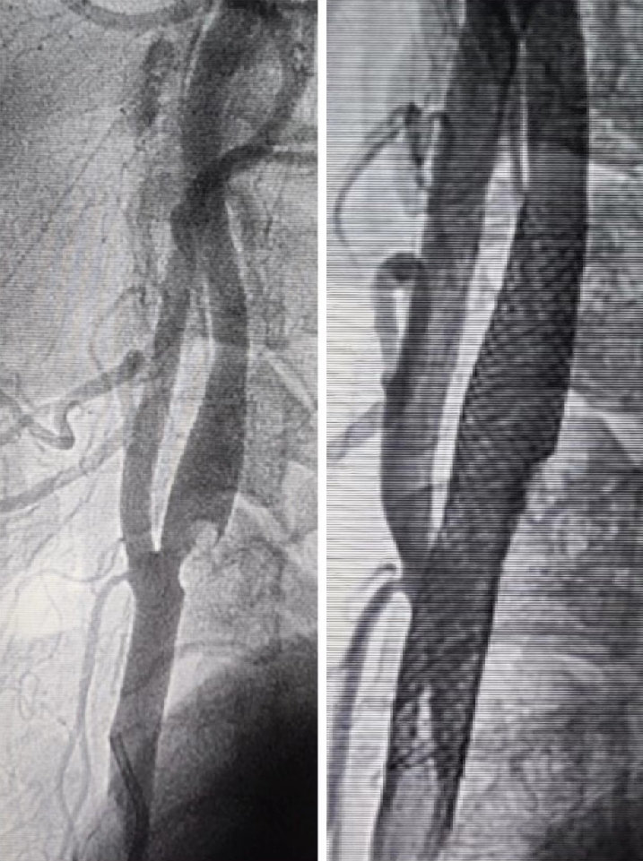 什么叫桡鞘Epath®长鞘经桡入路丨冯军教授团队：Epath®长鞘经桡入路行颈动脉狭窄CAS术一例_https://www.jmylbn.com_新闻资讯_第10张