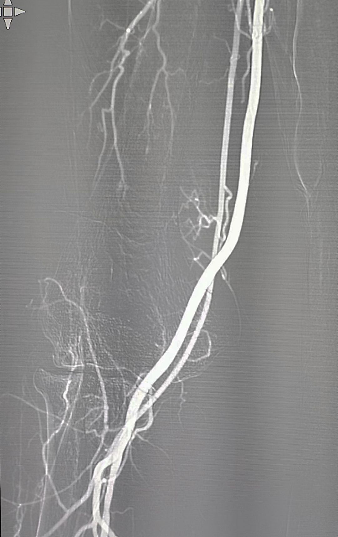 什么叫桡鞘Epath®长鞘经桡入路丨冯军教授团队：Epath®长鞘经桡入路行颈动脉狭窄CAS术一例_https://www.jmylbn.com_新闻资讯_第7张