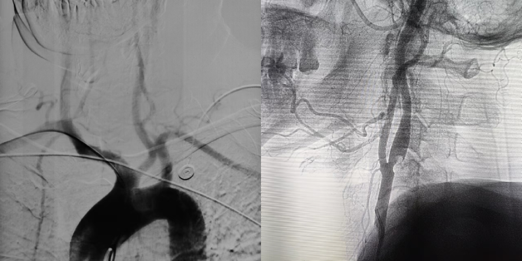 什么叫桡鞘Epath®长鞘经桡入路丨冯军教授团队：Epath®长鞘经桡入路行颈动脉狭窄CAS术一例_https://www.jmylbn.com_新闻资讯_第6张