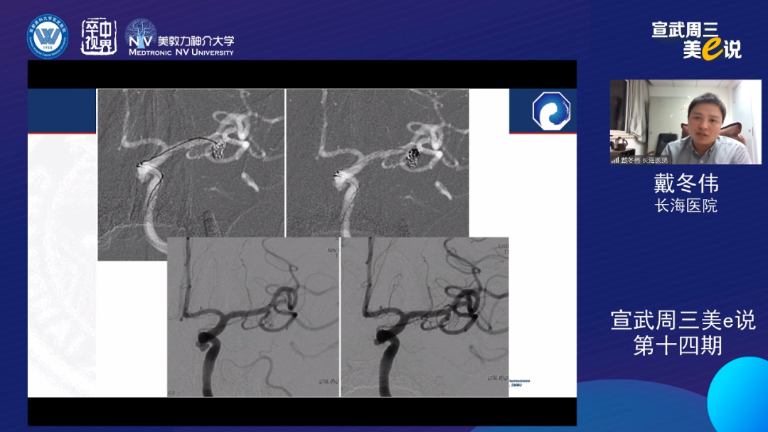 为什么要用到微导管精彩回顾 ｜ 「宣武周三美e说」第十四期——双微导管技术的深度解读_https://www.jmylbn.com_新闻资讯_第10张