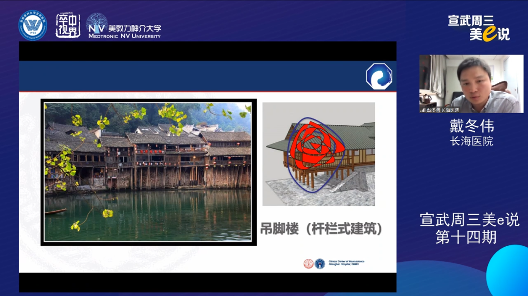 为什么要用到微导管精彩回顾 ｜ 「宣武周三美e说」第十四期——双微导管技术的深度解读_https://www.jmylbn.com_新闻资讯_第14张