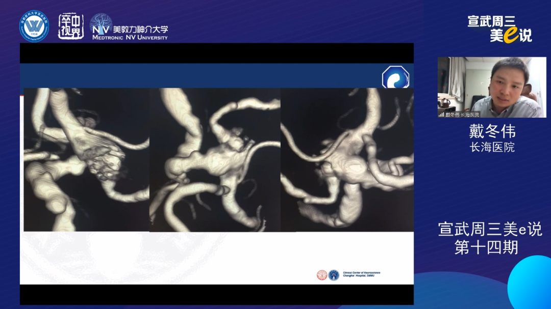 为什么要用到微导管精彩回顾 ｜ 「宣武周三美e说」第十四期——双微导管技术的深度解读_https://www.jmylbn.com_新闻资讯_第16张