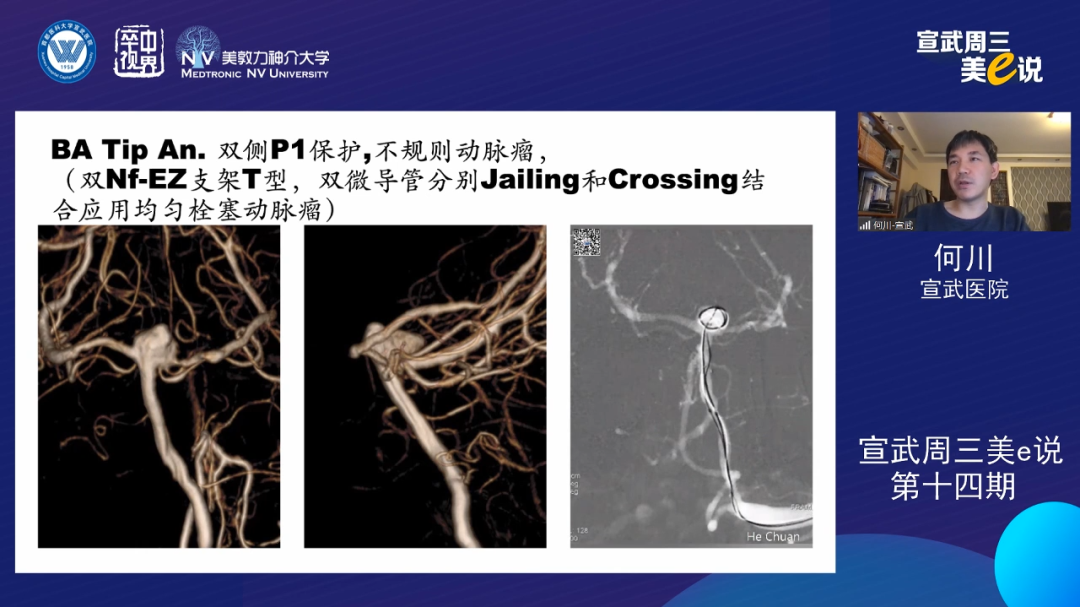 为什么要用到微导管精彩回顾 ｜ 「宣武周三美e说」第十四期——双微导管技术的深度解读_https://www.jmylbn.com_新闻资讯_第5张