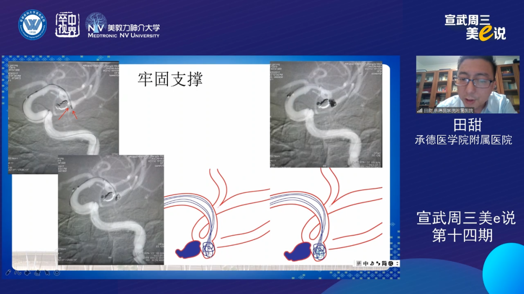 为什么要用到微导管精彩回顾 ｜ 「宣武周三美e说」第十四期——双微导管技术的深度解读_https://www.jmylbn.com_新闻资讯_第21张