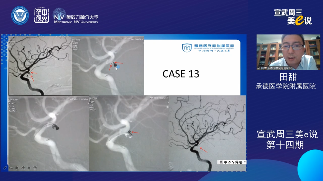 为什么要用到微导管精彩回顾 ｜ 「宣武周三美e说」第十四期——双微导管技术的深度解读_https://www.jmylbn.com_新闻资讯_第24张