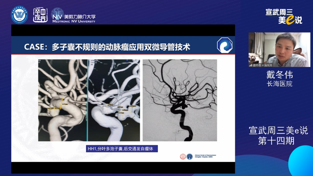 为什么要用到微导管精彩回顾 ｜ 「宣武周三美e说」第十四期——双微导管技术的深度解读_https://www.jmylbn.com_新闻资讯_第11张