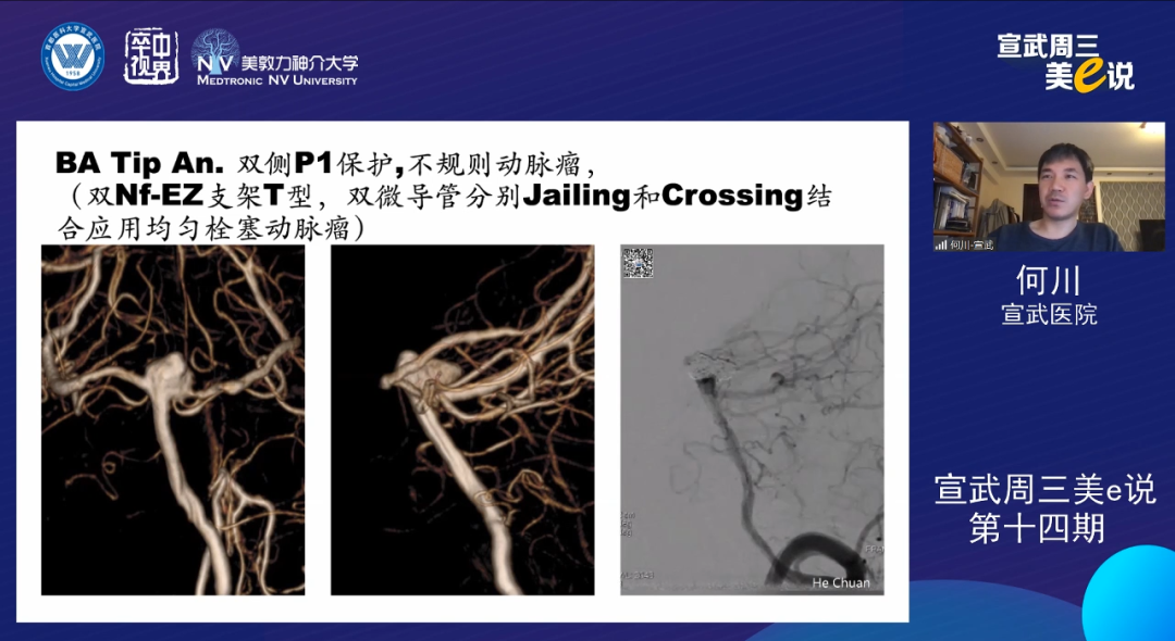 为什么要用到微导管精彩回顾 ｜ 「宣武周三美e说」第十四期——双微导管技术的深度解读_https://www.jmylbn.com_新闻资讯_第7张