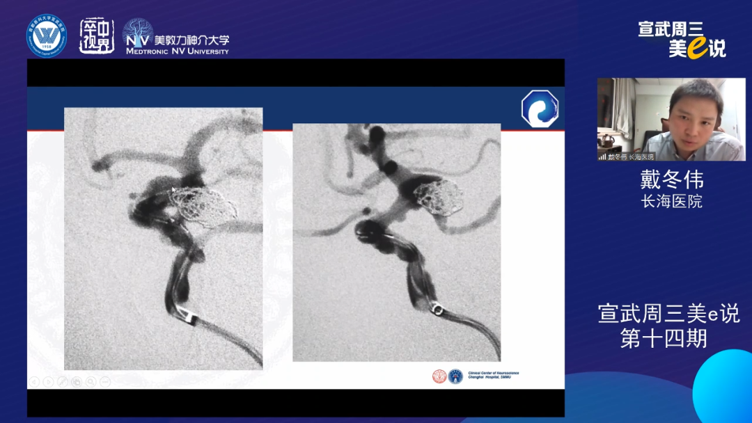 为什么要用到微导管精彩回顾 ｜ 「宣武周三美e说」第十四期——双微导管技术的深度解读_https://www.jmylbn.com_新闻资讯_第15张