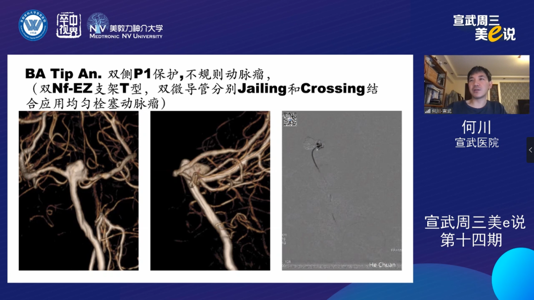 为什么要用到微导管精彩回顾 ｜ 「宣武周三美e说」第十四期——双微导管技术的深度解读_https://www.jmylbn.com_新闻资讯_第6张