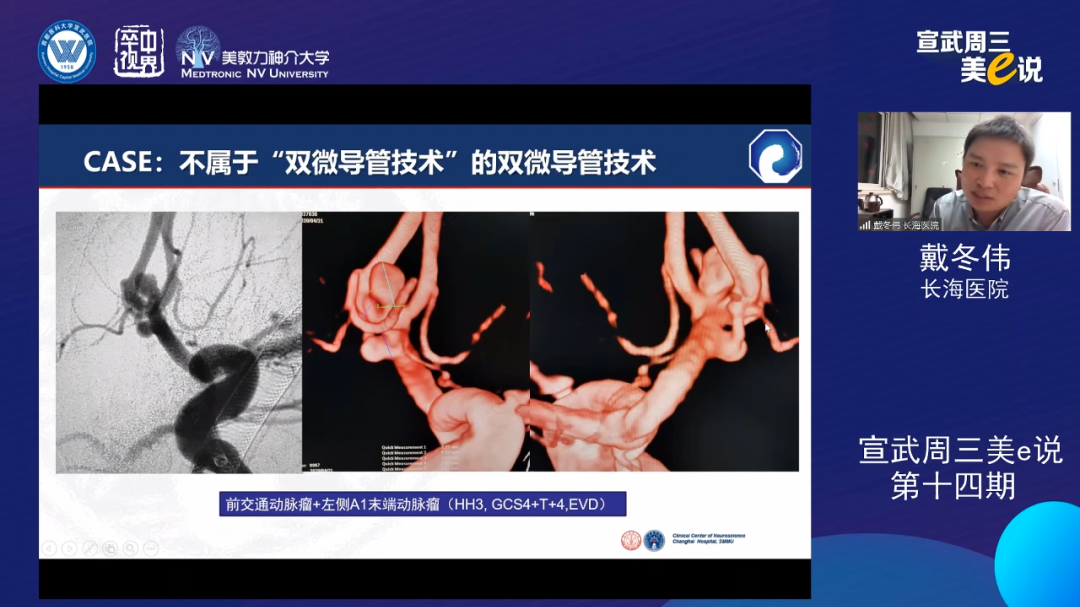 为什么要用到微导管精彩回顾 ｜ 「宣武周三美e说」第十四期——双微导管技术的深度解读_https://www.jmylbn.com_新闻资讯_第17张