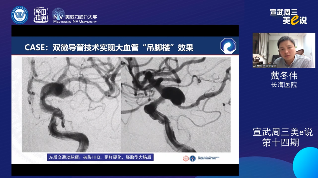为什么要用到微导管精彩回顾 ｜ 「宣武周三美e说」第十四期——双微导管技术的深度解读_https://www.jmylbn.com_新闻资讯_第13张