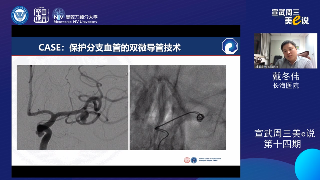 为什么要用到微导管精彩回顾 ｜ 「宣武周三美e说」第十四期——双微导管技术的深度解读_https://www.jmylbn.com_新闻资讯_第9张