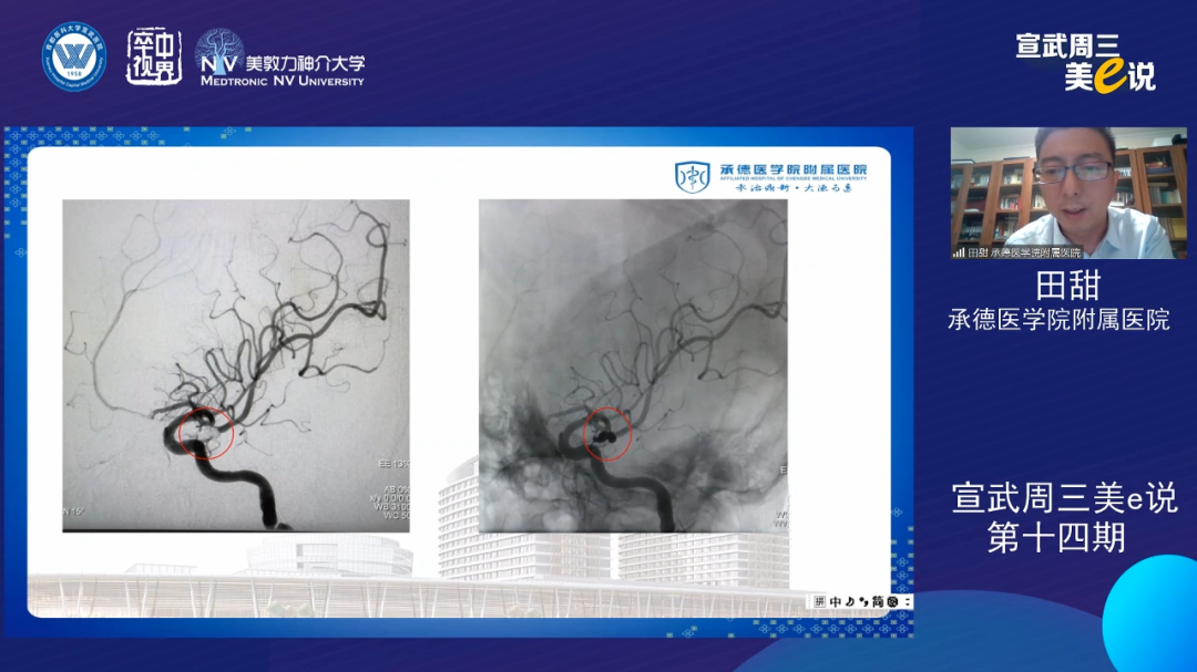 为什么要用到微导管精彩回顾 ｜ 「宣武周三美e说」第十四期——双微导管技术的深度解读_https://www.jmylbn.com_新闻资讯_第22张