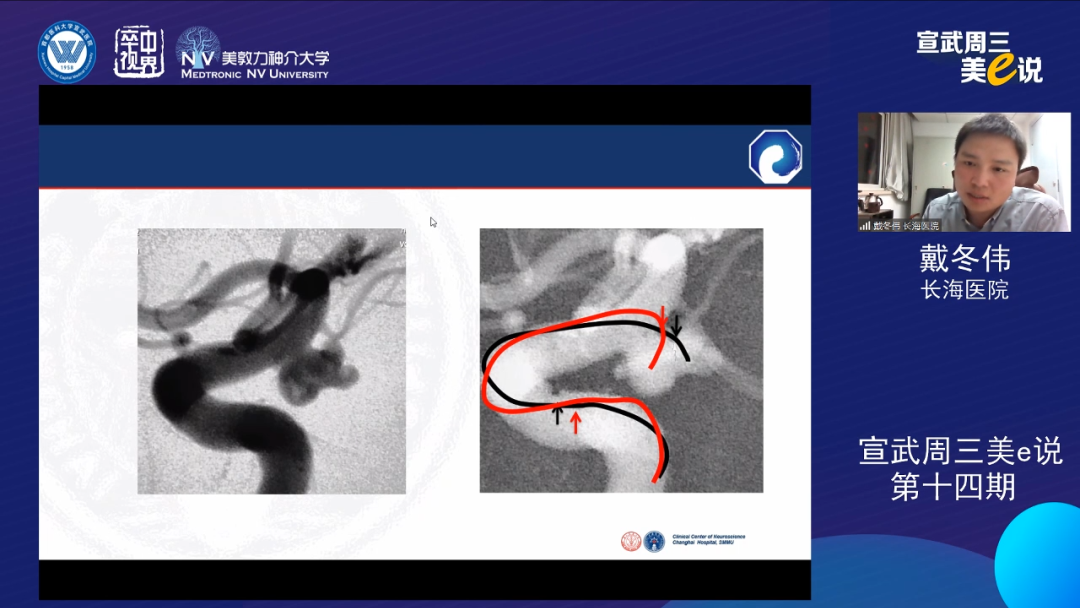 为什么要用到微导管精彩回顾 ｜ 「宣武周三美e说」第十四期——双微导管技术的深度解读_https://www.jmylbn.com_新闻资讯_第12张