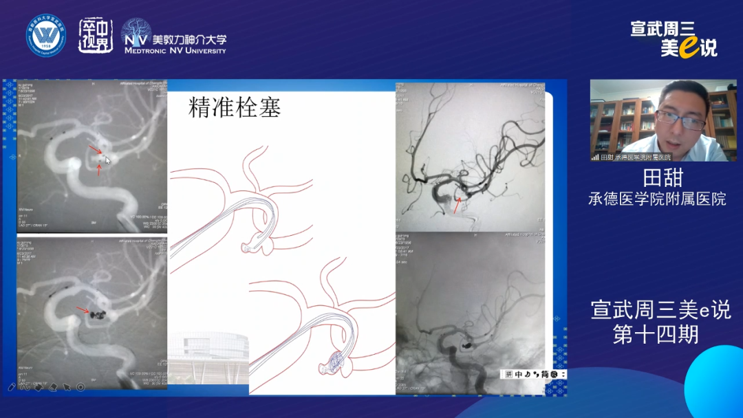 为什么要用到微导管精彩回顾 ｜ 「宣武周三美e说」第十四期——双微导管技术的深度解读_https://www.jmylbn.com_新闻资讯_第20张