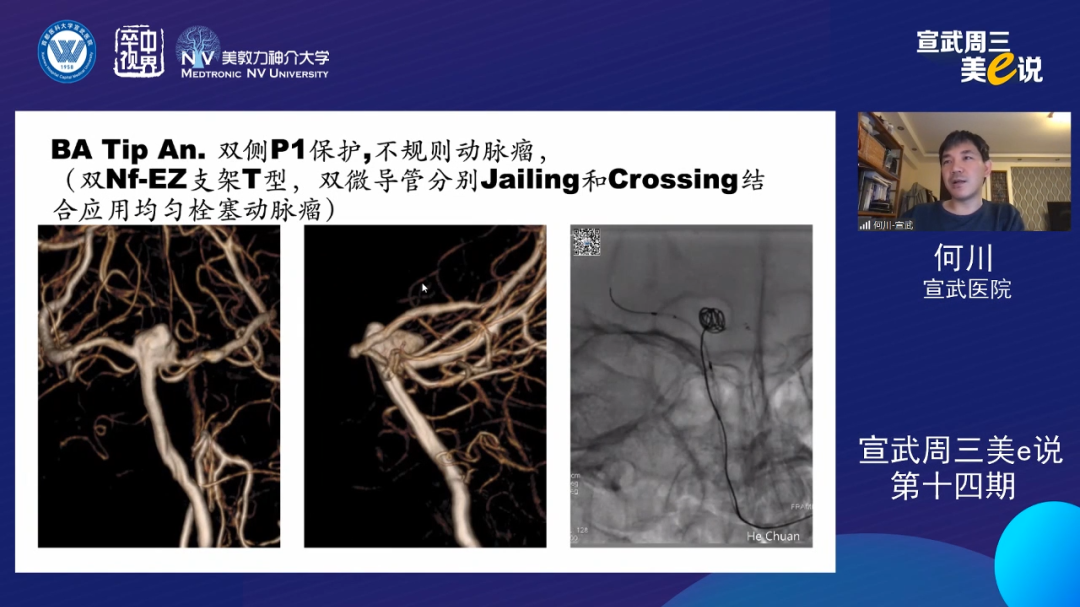 为什么要用到微导管精彩回顾 ｜ 「宣武周三美e说」第十四期——双微导管技术的深度解读_https://www.jmylbn.com_新闻资讯_第4张