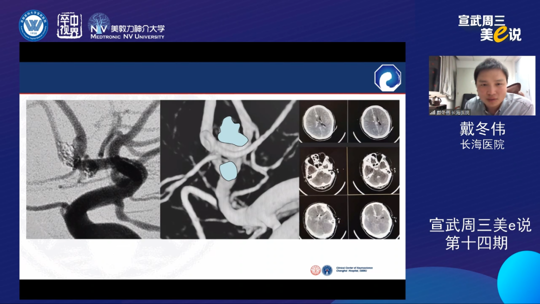 为什么要用到微导管精彩回顾 ｜ 「宣武周三美e说」第十四期——双微导管技术的深度解读_https://www.jmylbn.com_新闻资讯_第18张
