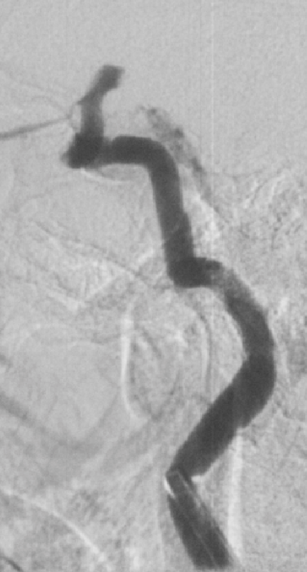 为什么要用到微导管介入面对迂曲  创新循迹导航——导航微导管初体验_https://www.jmylbn.com_新闻资讯_第8张