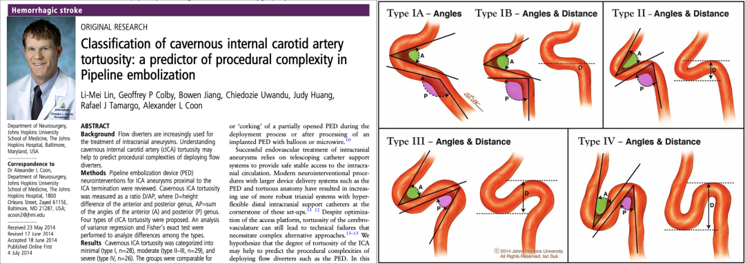 为什么要用到微导管介入面对迂曲  创新循迹导航——导航微导管初体验_https://www.jmylbn.com_新闻资讯_第3张