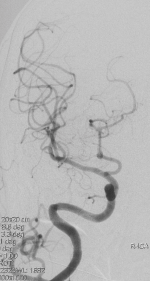 为什么要用到微导管介入面对迂曲  创新循迹导航——导航微导管初体验_https://www.jmylbn.com_新闻资讯_第9张