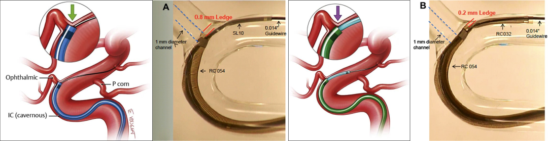 为什么要用到微导管介入面对迂曲  创新循迹导航——导航微导管初体验_https://www.jmylbn.com_新闻资讯_第5张