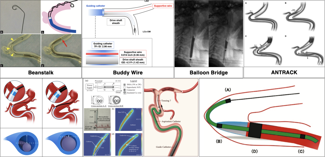 为什么要用到微导管介入面对迂曲  创新循迹导航——导航微导管初体验_https://www.jmylbn.com_新闻资讯_第6张