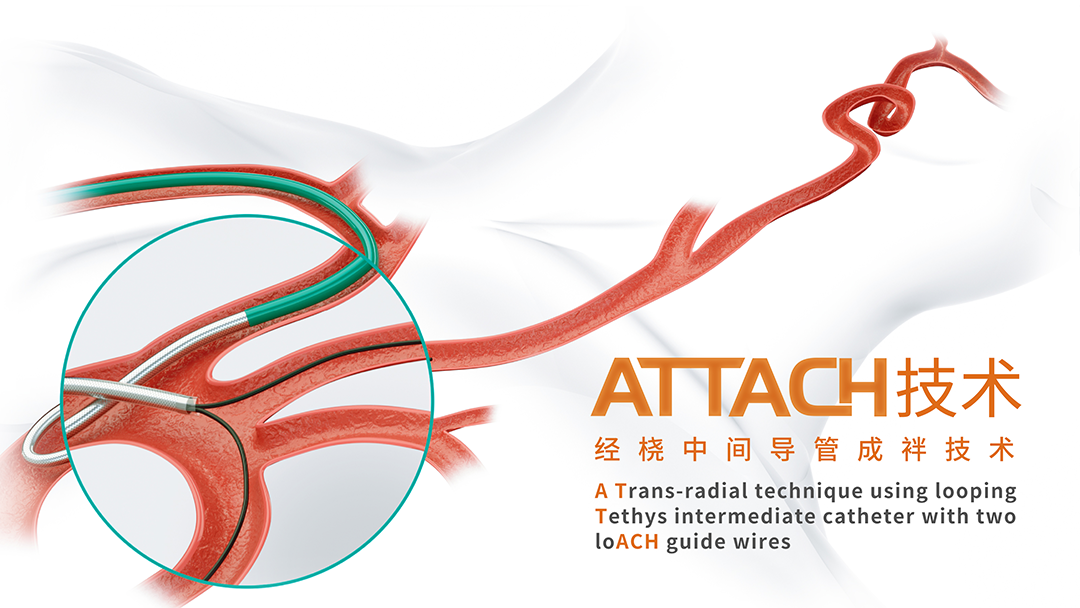 泥鳅导丝怎么用盘途问路，桡行而至丨ATTACH经桡中间导管成袢技术详解_https://www.jmylbn.com_新闻资讯_第2张