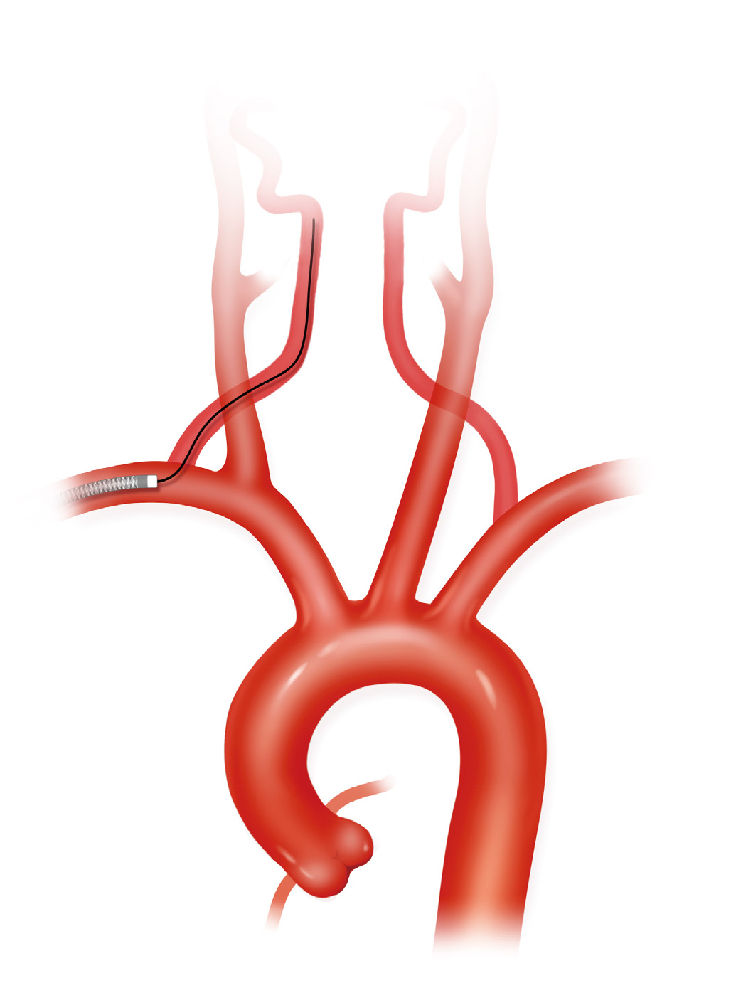 泥鳅导丝怎么用上行道简，桡遇而安丨REST经桡中间导管简化技术详解_https://www.jmylbn.com_新闻资讯_第34张