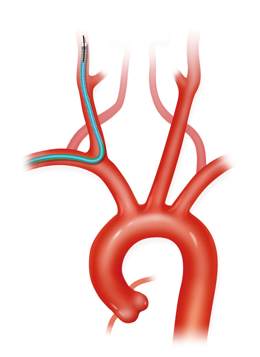 泥鳅导丝怎么用上行道简，桡遇而安丨REST经桡中间导管简化技术详解_https://www.jmylbn.com_新闻资讯_第14张