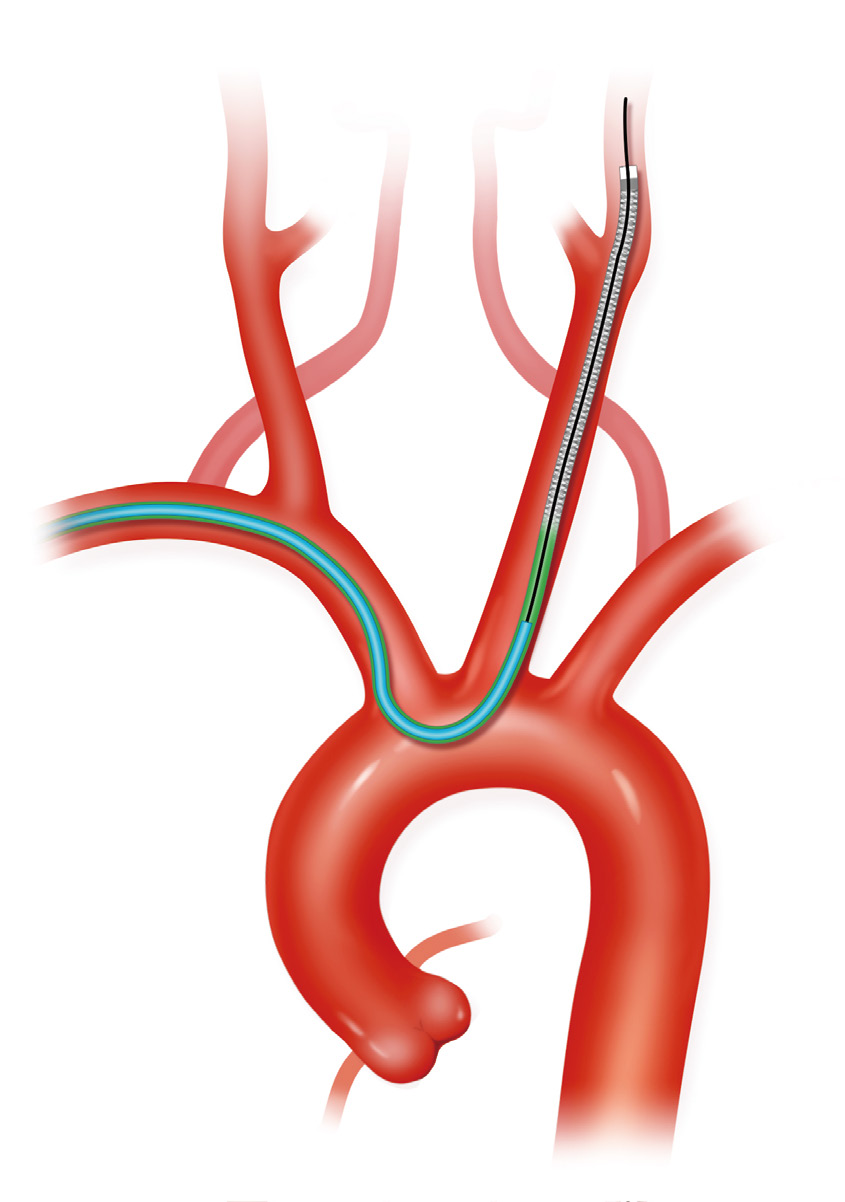 泥鳅导丝怎么用上行道简，桡遇而安丨REST经桡中间导管简化技术详解_https://www.jmylbn.com_新闻资讯_第26张