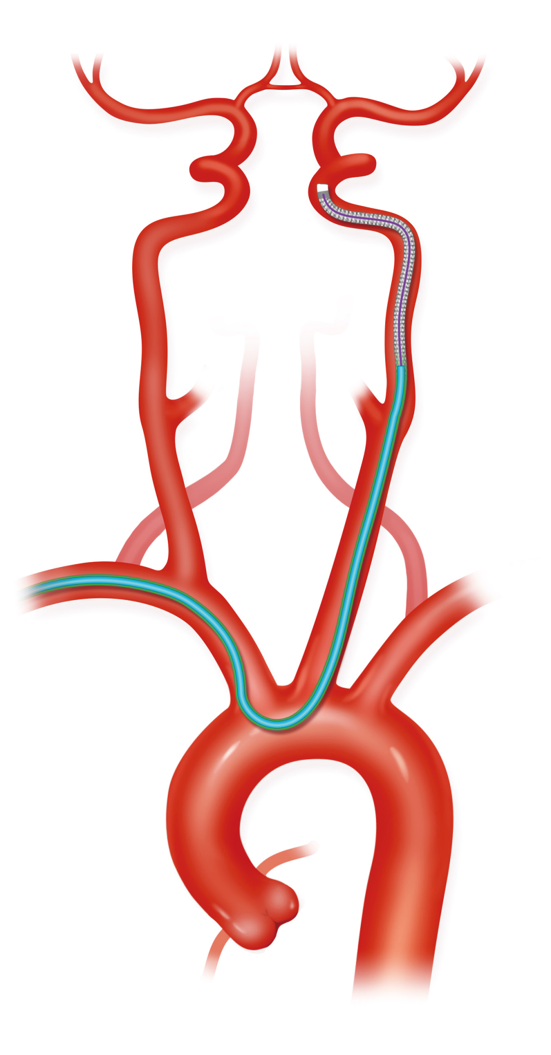 泥鳅导丝怎么用上行道简，桡遇而安丨REST经桡中间导管简化技术详解_https://www.jmylbn.com_新闻资讯_第30张