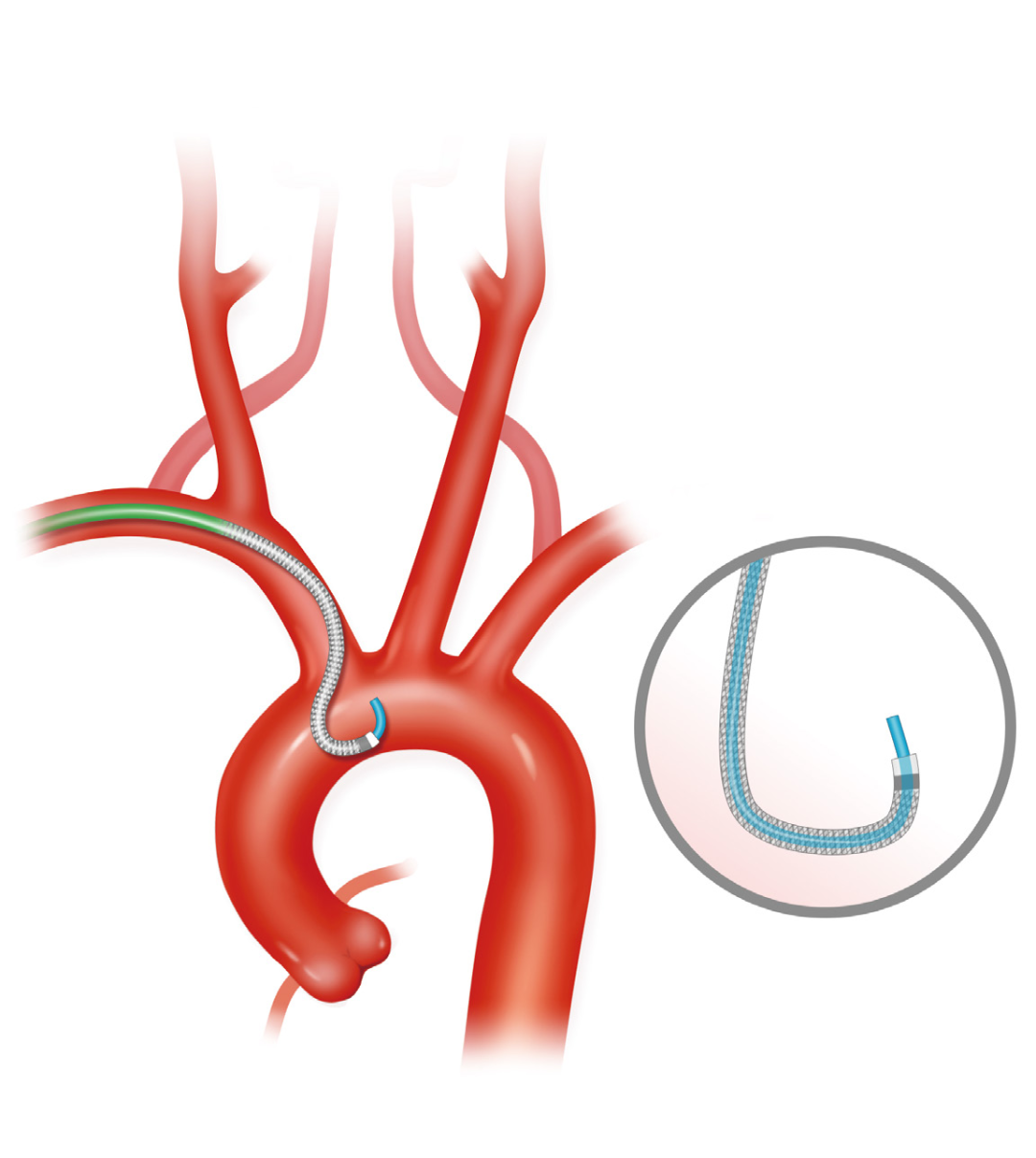 泥鳅导丝怎么用上行道简，桡遇而安丨REST经桡中间导管简化技术详解_https://www.jmylbn.com_新闻资讯_第22张
