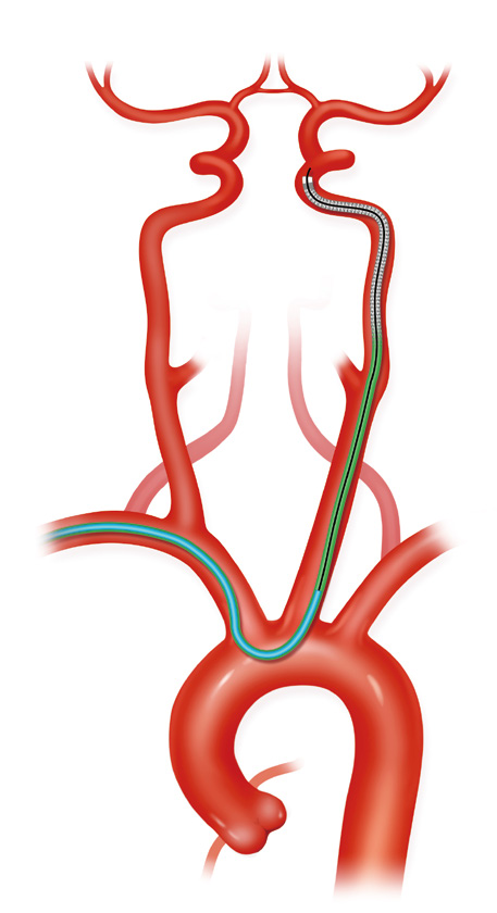 泥鳅导丝怎么用上行道简，桡遇而安丨REST经桡中间导管简化技术详解_https://www.jmylbn.com_新闻资讯_第27张