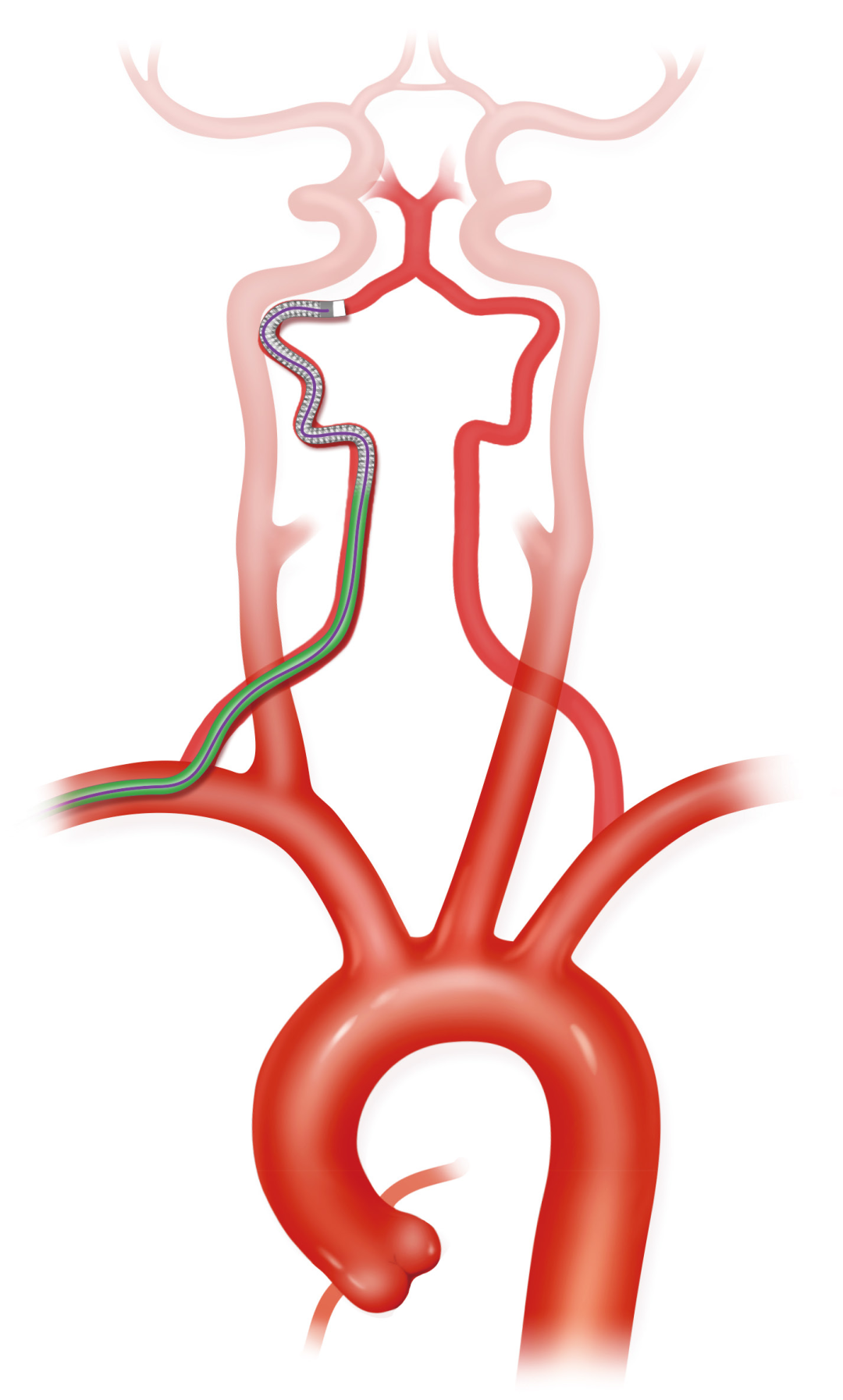 泥鳅导丝怎么用上行道简，桡遇而安丨REST经桡中间导管简化技术详解_https://www.jmylbn.com_新闻资讯_第38张