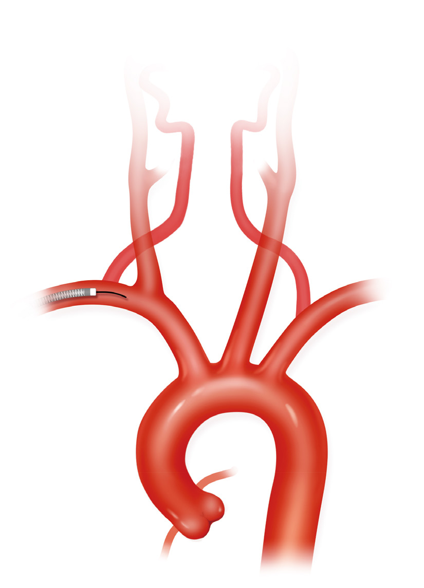 泥鳅导丝怎么用上行道简，桡遇而安丨REST经桡中间导管简化技术详解_https://www.jmylbn.com_新闻资讯_第33张