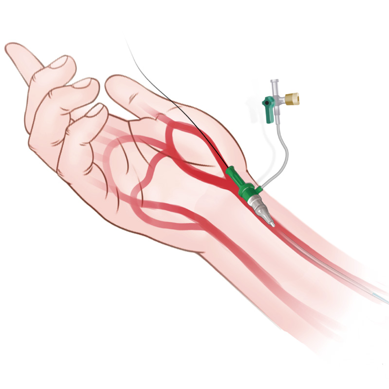 泥鳅导丝怎么用上行道简，桡遇而安丨REST经桡中间导管简化技术详解_https://www.jmylbn.com_新闻资讯_第5张
