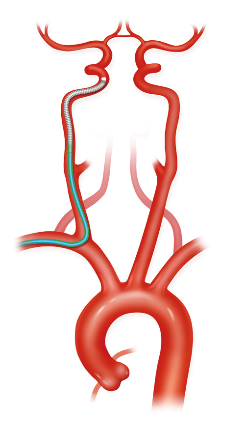 泥鳅导丝怎么用上行道简，桡遇而安丨REST经桡中间导管简化技术详解_https://www.jmylbn.com_新闻资讯_第16张