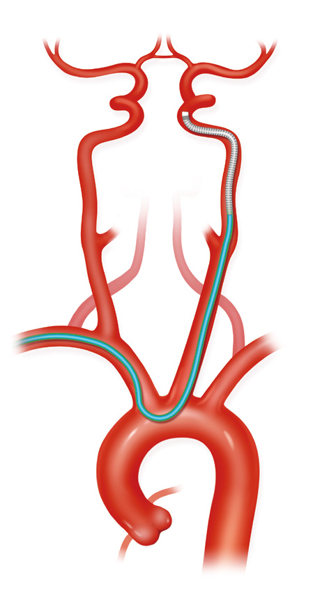 泥鳅导丝怎么用上行道简，桡遇而安丨REST经桡中间导管简化技术详解_https://www.jmylbn.com_新闻资讯_第29张