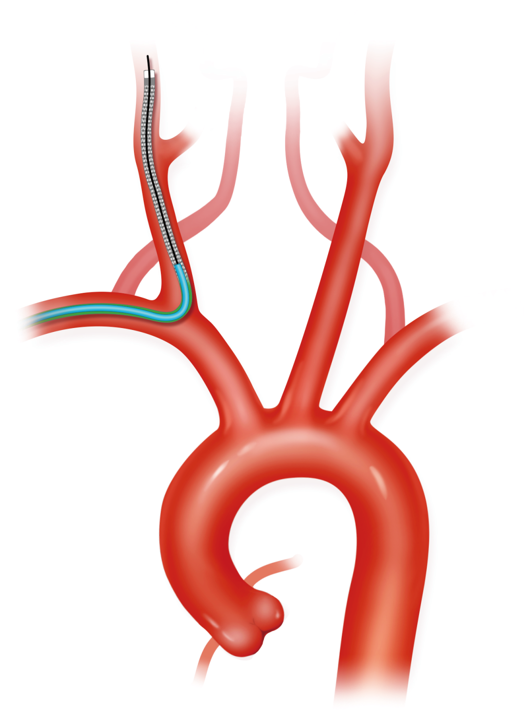 泥鳅导丝怎么用上行道简，桡遇而安丨REST经桡中间导管简化技术详解_https://www.jmylbn.com_新闻资讯_第13张
