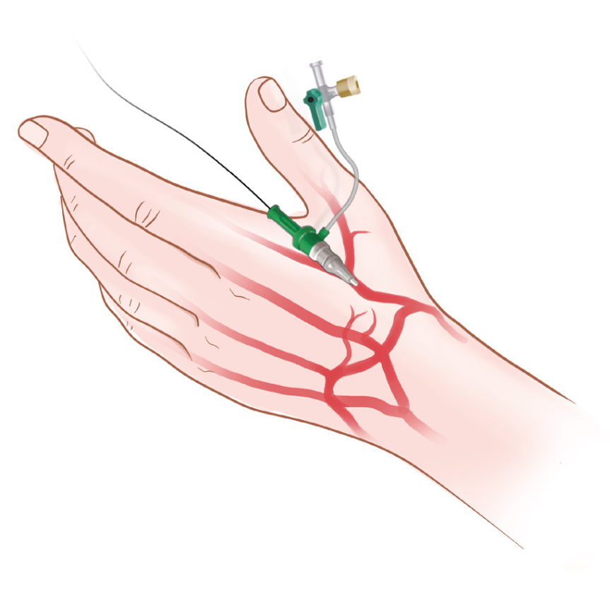 泥鳅导丝怎么用上行道简，桡遇而安丨REST经桡中间导管简化技术详解_https://www.jmylbn.com_新闻资讯_第7张