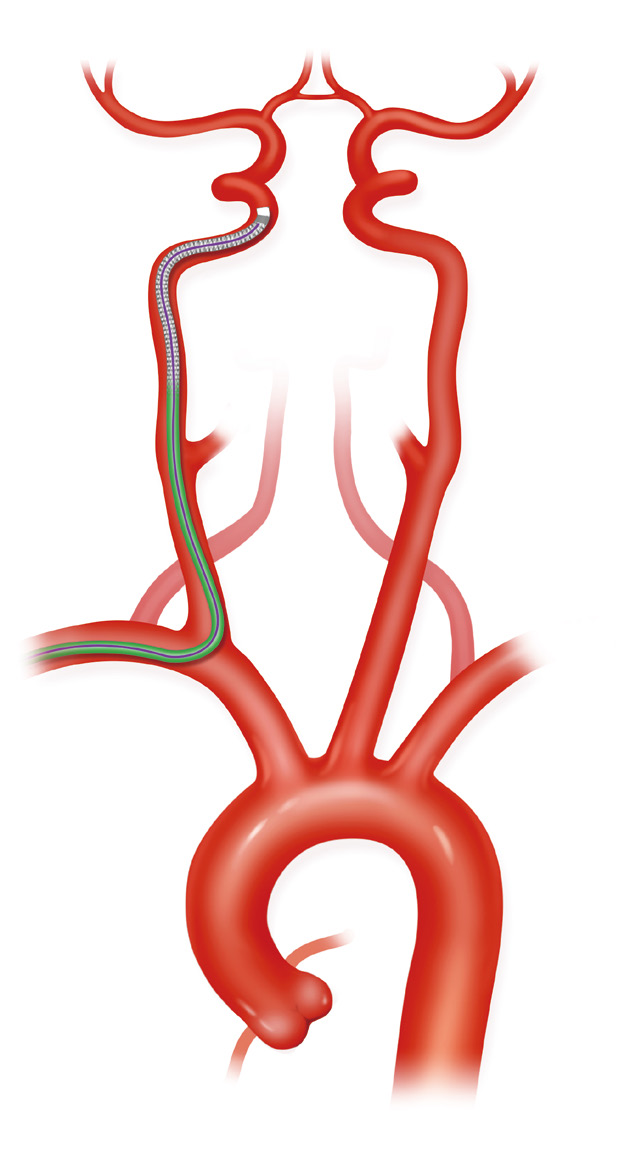 泥鳅导丝怎么用上行道简，桡遇而安丨REST经桡中间导管简化技术详解_https://www.jmylbn.com_新闻资讯_第18张