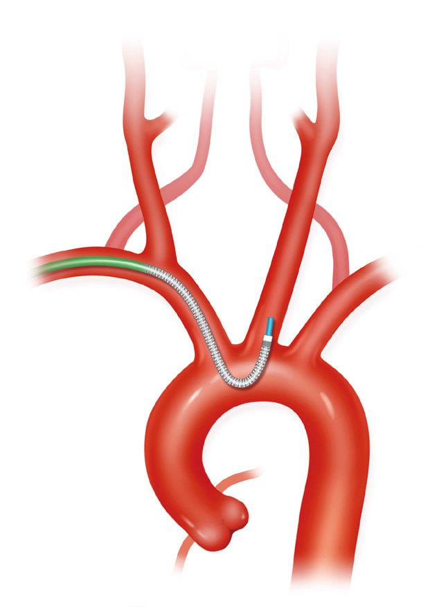泥鳅导丝怎么用上行道简，桡遇而安丨REST经桡中间导管简化技术详解_https://www.jmylbn.com_新闻资讯_第24张