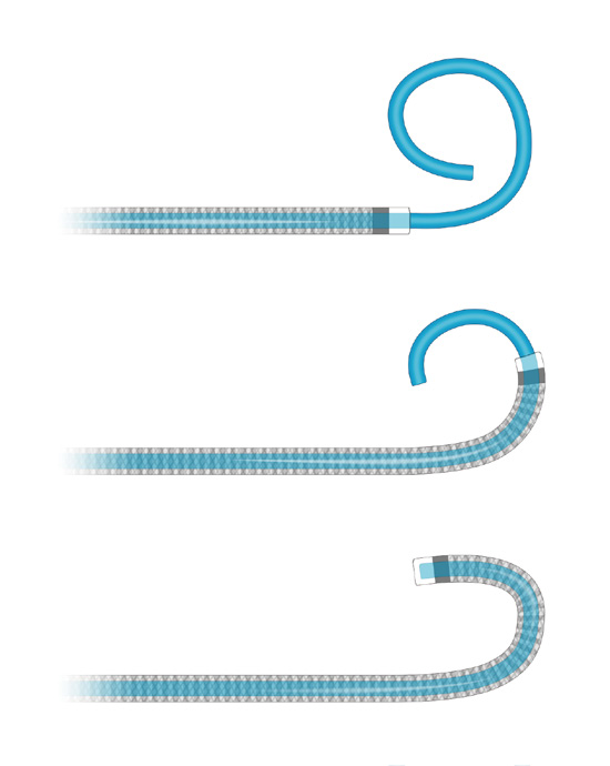 泥鳅导丝怎么用上行道简，桡遇而安丨REST经桡中间导管简化技术详解_https://www.jmylbn.com_新闻资讯_第23张