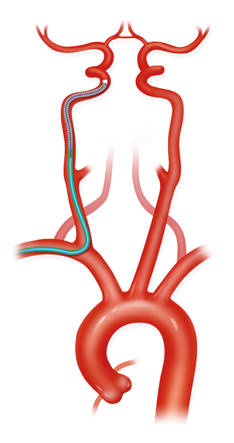 泥鳅导丝怎么用上行道简，桡遇而安丨REST经桡中间导管简化技术详解_https://www.jmylbn.com_新闻资讯_第17张