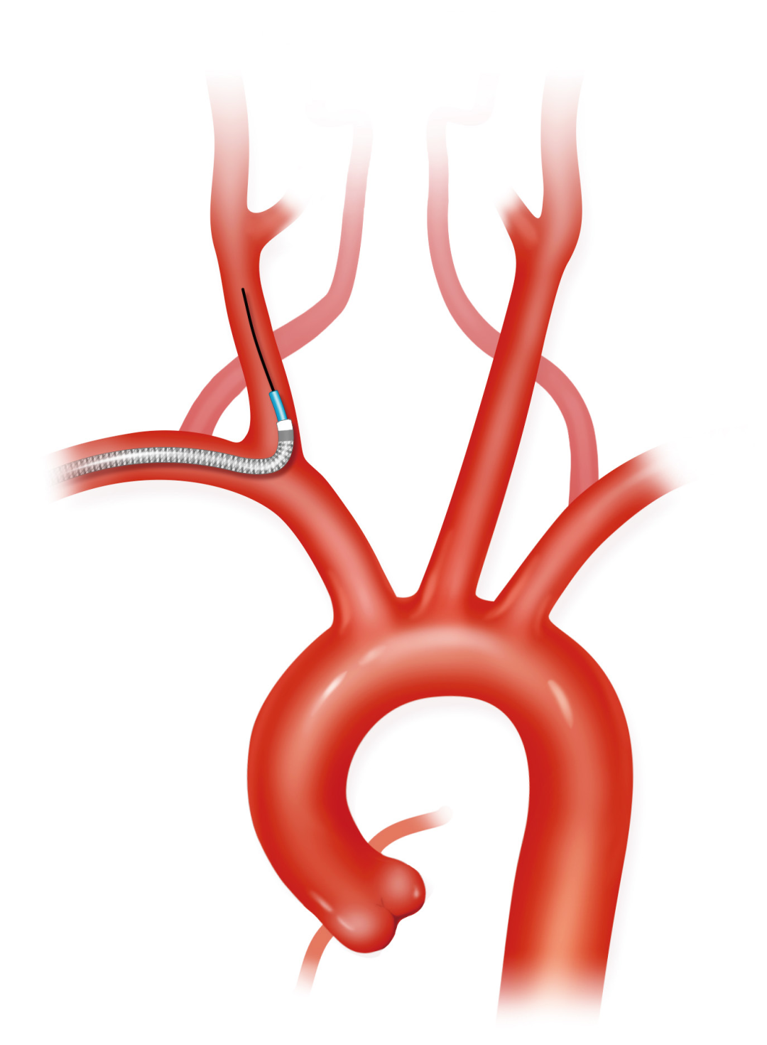 泥鳅导丝怎么用上行道简，桡遇而安丨REST经桡中间导管简化技术详解_https://www.jmylbn.com_新闻资讯_第12张